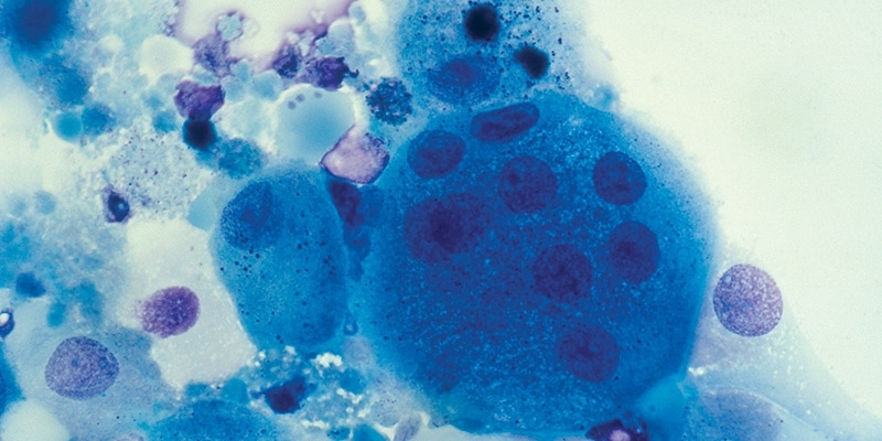 Cells with HIV as viewed through a microscope.