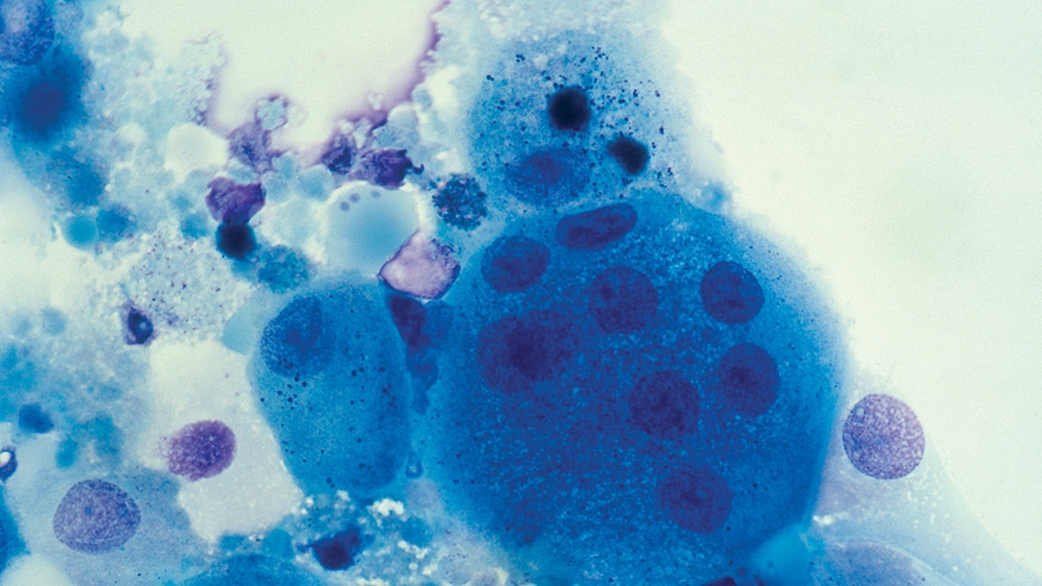 Cells with HIV as viewed through a microscope.