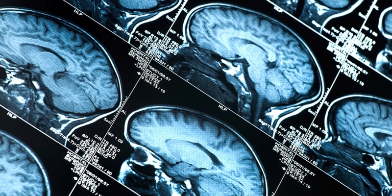 X-rays of brains.